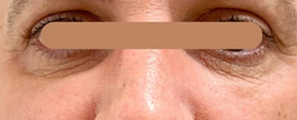 Preenchimento da região infraorbital (olheiras) — Masculino: antes