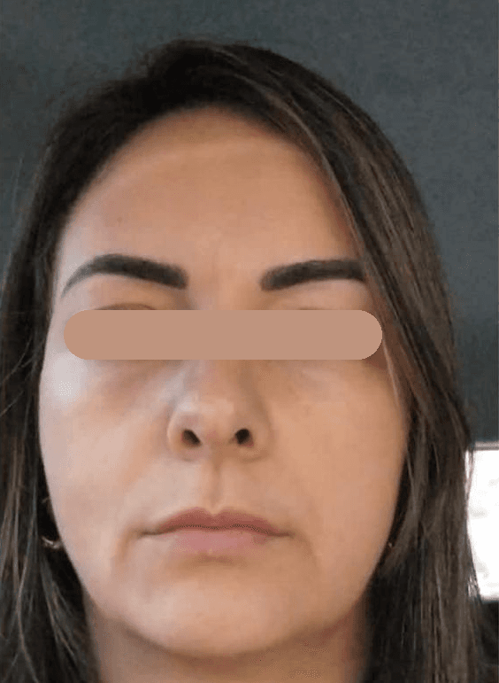 Fios de sustentação: depois