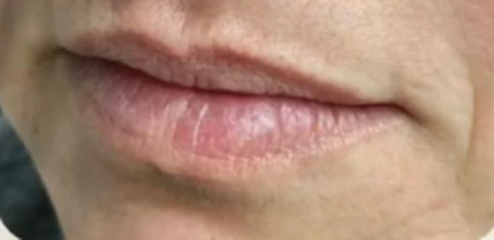 Preenchimento labial: antes