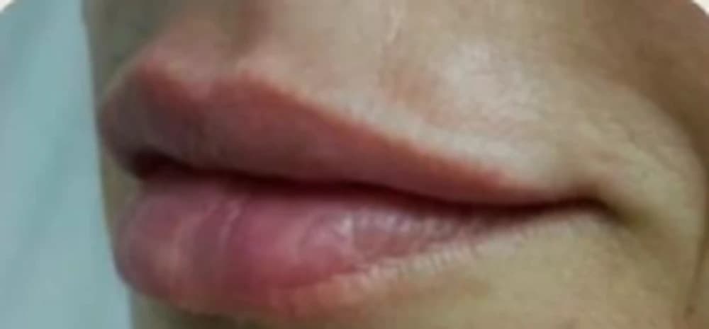 Preenchimento labial: depois