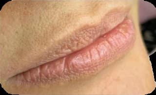 Preenchimento labial: antes