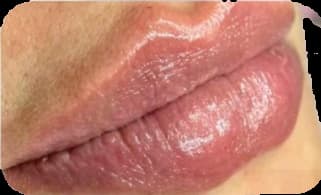 Preenchimento labial: depois