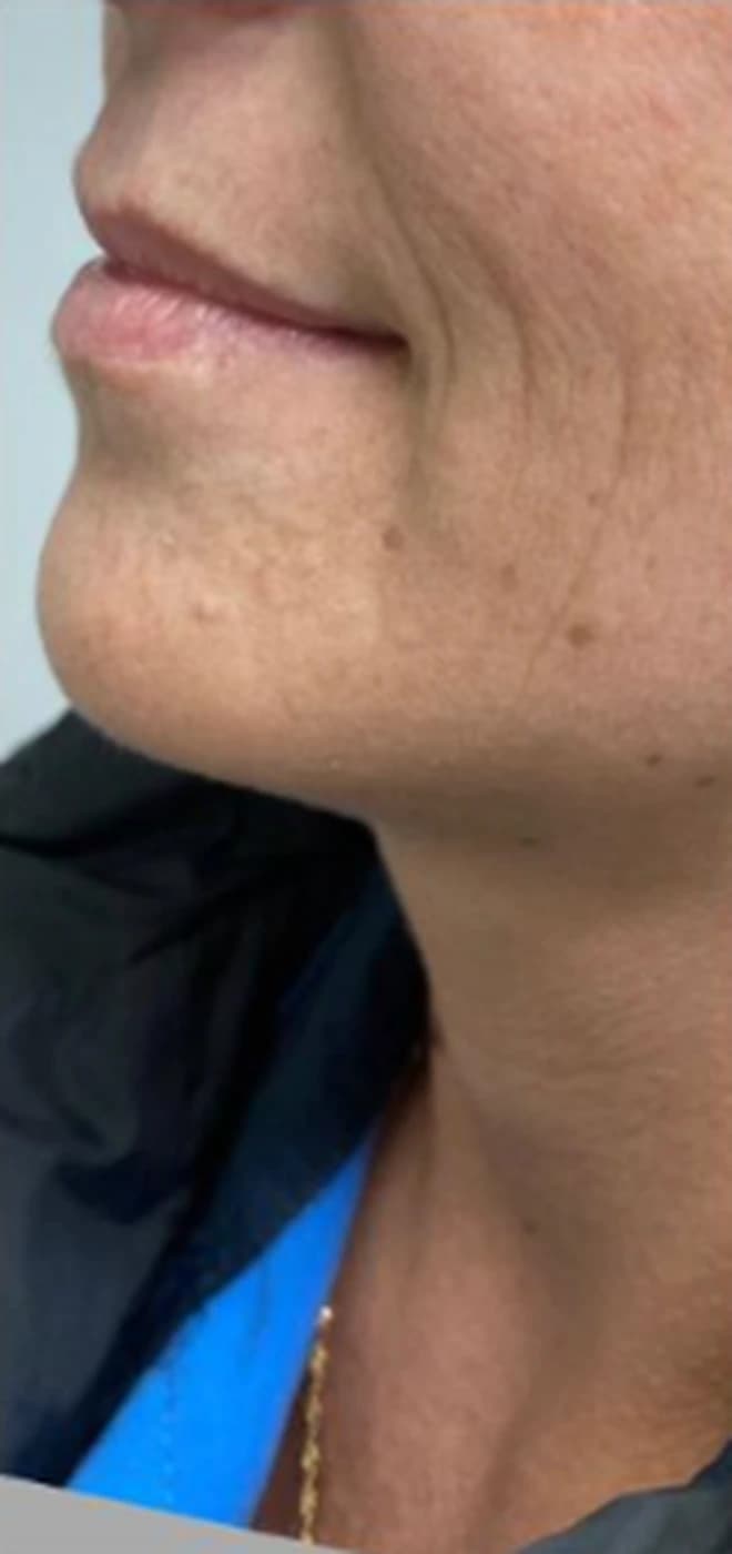 Preenchimento labial em perfil: antes