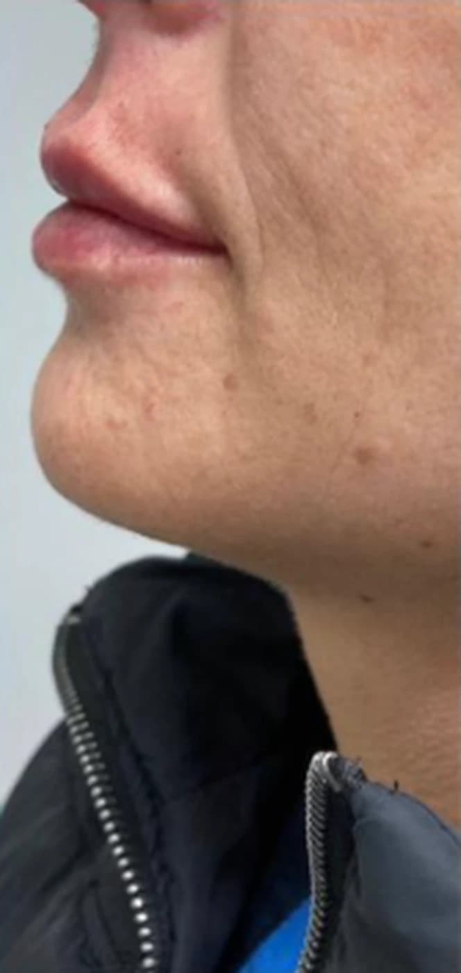 Preenchimento labial em perfil: depois
