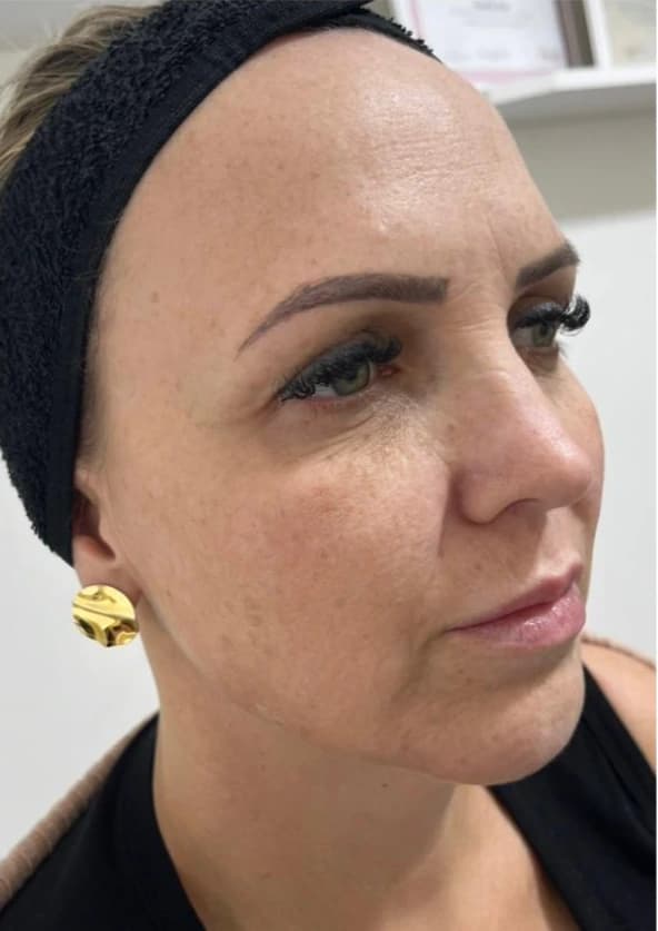 Harmonização facial — região mentoniana (queixo), contorno e lábios: depois