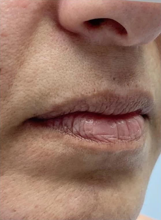 Preenchimento labial: antes
