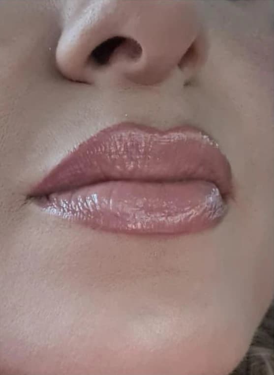 Preenchimento labial: depois