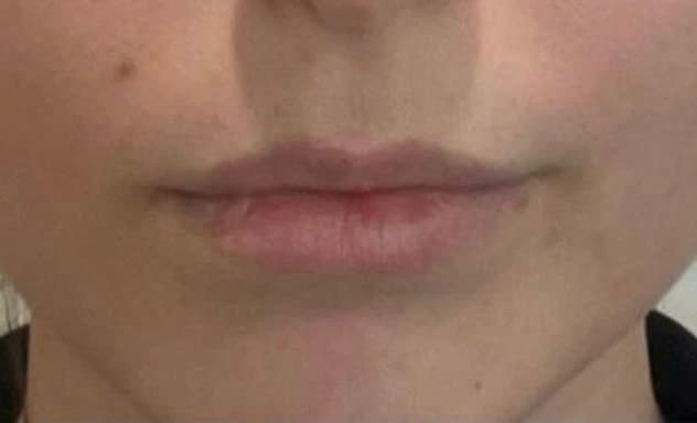 Preenchimento labial: antes