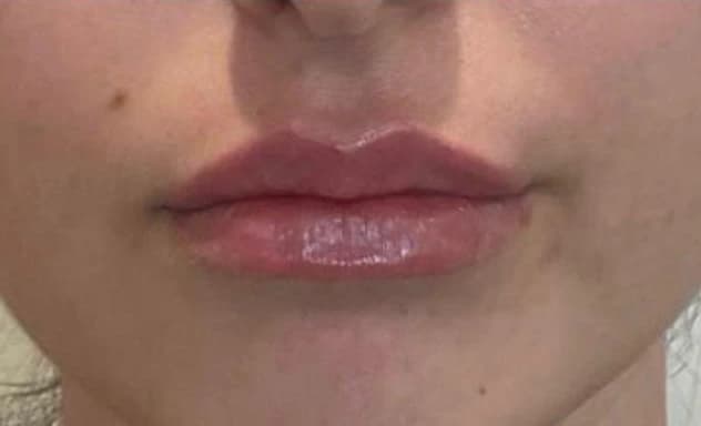 Preenchimento labial: depois
