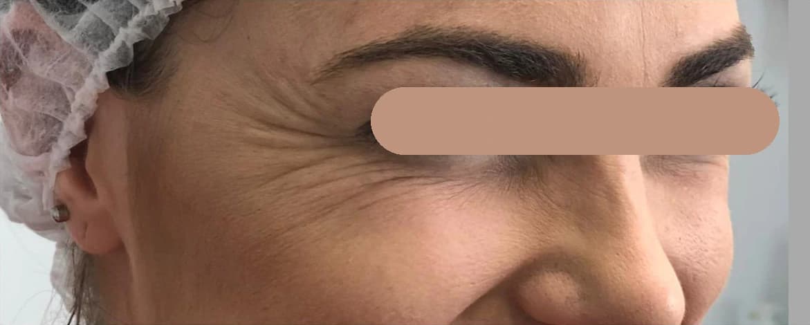 Toxina botulínica — região periorbital lateral (pés de galinha): antes