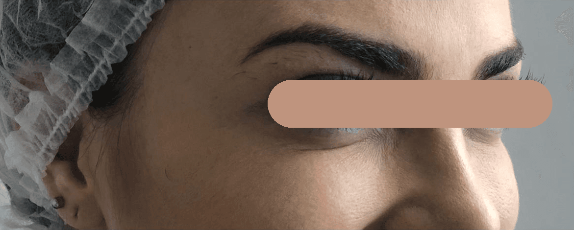 Toxina botulínica — região periorbital lateral (pés de galinha): depois