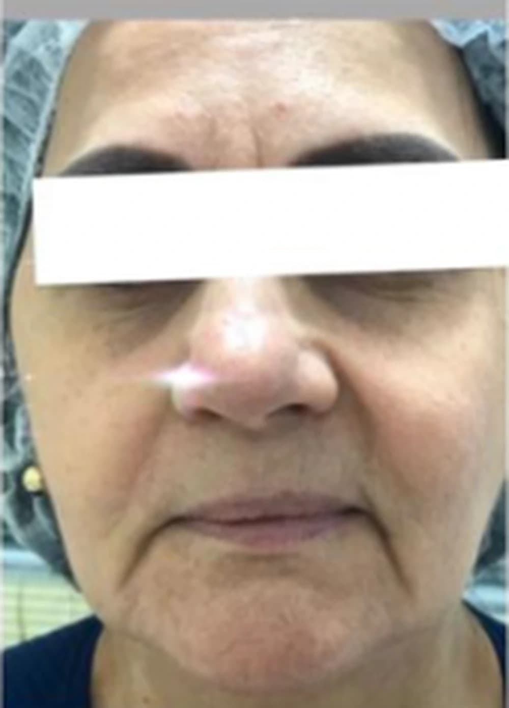 Harmonização facial: antes