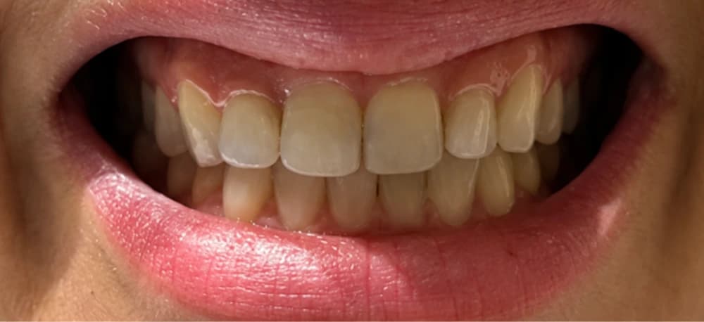 Toxina botulínica no sorriso gengival: antes