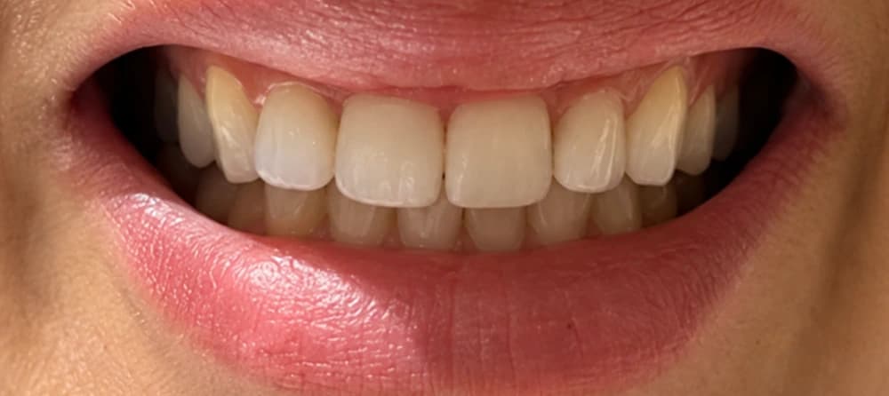 Toxina botulínica no sorriso gengival: depois
