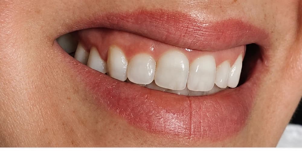 Correção do sorriso gengival: sorriso em detalhe