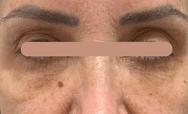 Preenchimento da região infraorbital (olheiras) — Feminino: antes