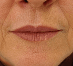 Preenchimento labial: antes