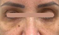 Preenchimento da região infraorbital (olheiras) — Feminino: registro antes do procedimento