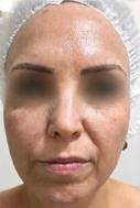 Harmonização facial: registro antes do procedimento