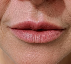 Preenchimento labial: registro depois do procedimento